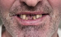 Комплексная имплантация всех зубов - Фотография 2
