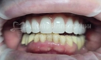 Восстановление зубов верхней челюсти на имплантах - Фотография 2