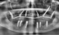 Восстановление зубов на обеих челюстях при пародонтозе - Фотография 4