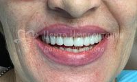 Имплантация зубов - Фотография 1