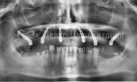 Восстановление зубов на верхней челюсти при пародонтозе - Фотография 2