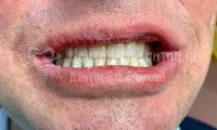 Полное восстановление зубов по протоколу «All-on-6» - Фотография 3