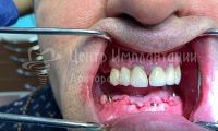 Восстановление зубов на нижней челюсти - Фотография 1