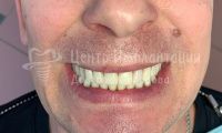 Восстановление обоих зубных рядов - Фотография 1