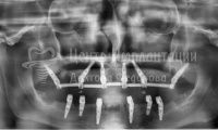Восстановление зубов на обеих челюстях - Фотография 4
