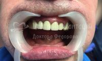 Восстановление зубов на обеих челюстях при парадонтозе - Фотография 3