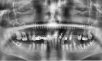 Восстановление зубов на обеих челюстях при парадонтозе - Фотография 1
