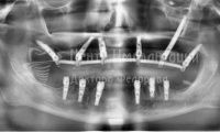 Восстановление зубов на двух челюстях при парадонтозе - Фотография 4