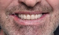 Комплексная имплантация всех зубов - Фотография 1