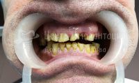 Восстановление зубов на верхней челюсти при пародонтозе - Фотография 3