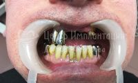 Восстановление зубов на верхней челюсти - Фотография 3