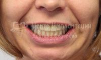 Восстановление зубов верхней и нижней челюсти - Фотография 3