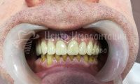 Восстановление зубов на верхней челюсти при пародонтозе - Фотография 4