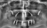 Восстановление зубов на двух челюстях - Фотография 4