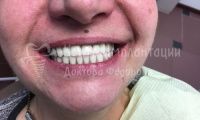 Восстановление зубов за 2 дня - Фотография 2