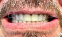 Имплантация зубов - Фотография 1
