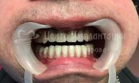 Восстановление зубов на двух челюстях при парадонтозе - Фотография 4