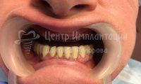 Восстановление зубов на верхней челюсти - Фотография 1
