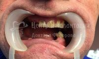Восстановление зубов на двух челюстях - Фотография 1