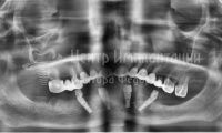 Восстановление зубов на нижней челюсти - Фотография 2