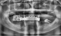 Восстановление зубов на нижней челюсти - Фотография 3