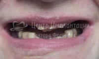 Комплексная имплантация верхнего и нижнего ряда зубов - Фотография 2