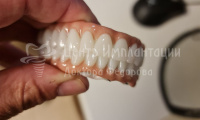 Имплантация зубов Все-на-6 на верхней и нижней челюсти - Фотография 4