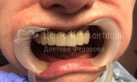 Восстановление зубов на верхней и нижней челюсти - Фотография 1