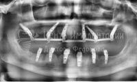 Восстановление зубов на обеих челюстях при парадонтозе - Фотография 2