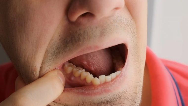 Боль после удаления зуба мудрости – в чем причина и что делать?