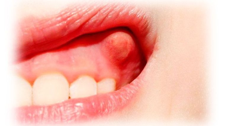 Язвенное поражение и воспаление губ