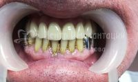 Восстановление зубов на верхней челюсти - Фотография 4