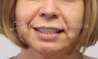 Восстановление зубов верхней и нижней челюсти - Фотография 2