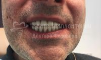 Восстановление зубов при пародонтозе - Фотография 2