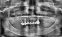 Восстановление эстетики всех зубов - Фотография 1