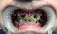 Восстановление зубов на двух челюстях при парадонтозе - Фотография 3