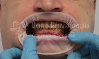 Имплантация верхней челюсти по методу 