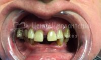 Восстановление зубов на обеих челюстях при пародонтозе - Фотография 1