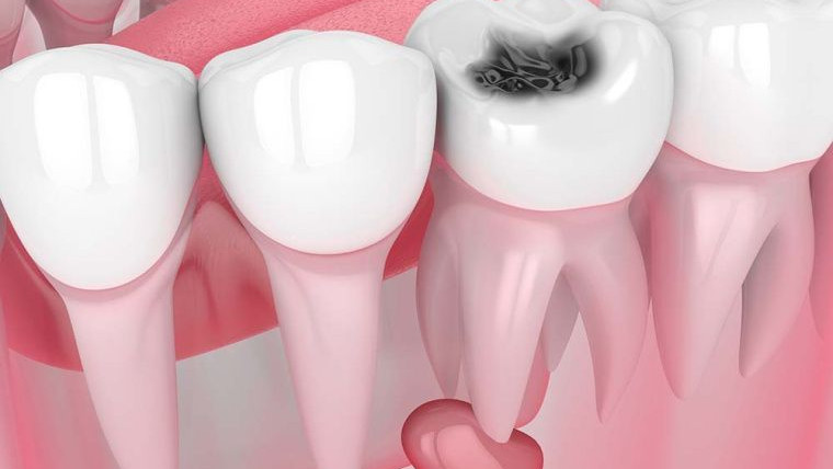 Удаление кисты зуба: отек и реабилитация