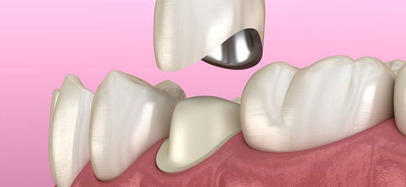 Протезирование зубов с помощью металлокерамической коронки