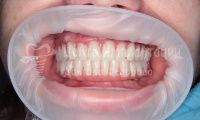 Восстановление зубов на верхней и нижней челюстях - Фотография 2