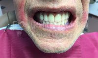 Восстановление зубов на верхней челюсти - Фотография 2
