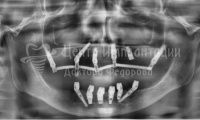 Восстановление эстетики всех зубов - Фотография 2