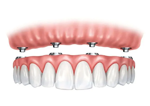 Популярные вопросы об имплантации зубов