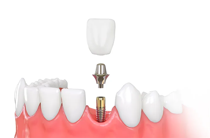 Импланты зубов «под ключ» по цене от 35 ₽ с коронкой