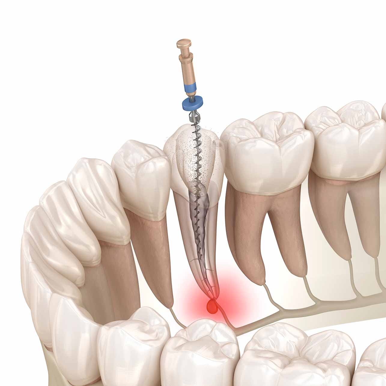Лечение зуба и корневого канала