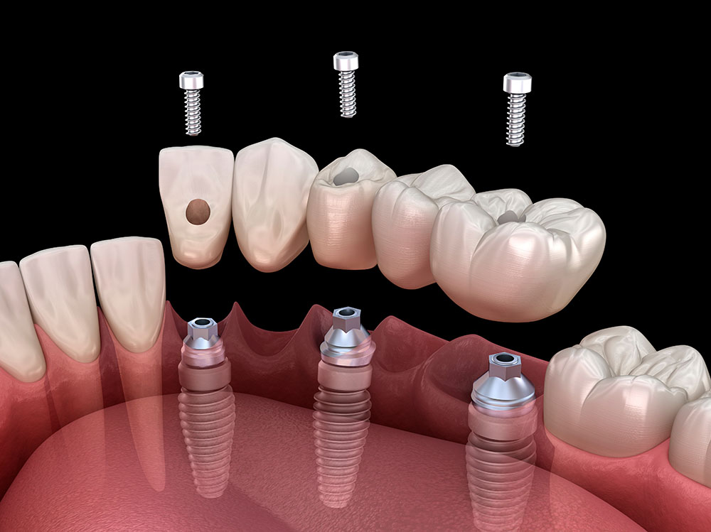Мост на имплантах для восстановления 5 зубов