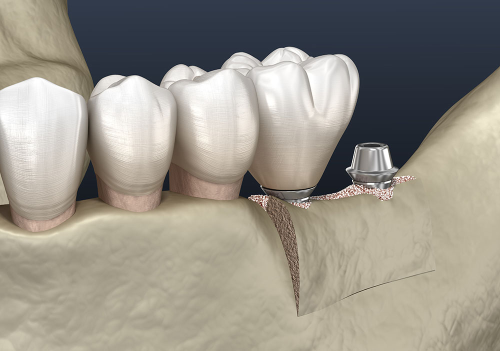 Расщепление альвеолярного гребня для установки зубного импланта