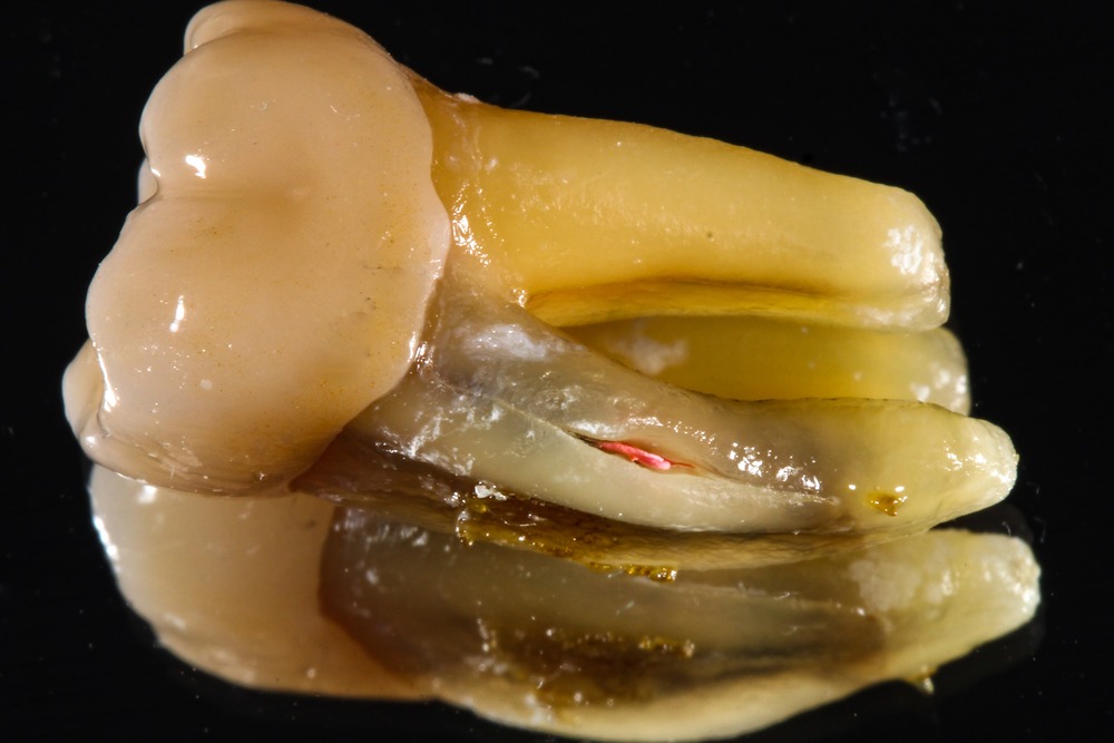 Удаленный зуб со сломанным корнем и явным инфекционным проникновением в пульпу