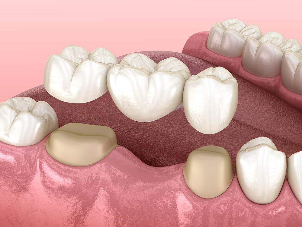 Зубной мост из трех коронок для восстановления одного отсутствующего зуба